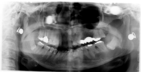 Extraction des dents de sagesse