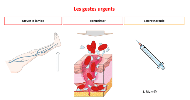 Généralités sur les varices 10 gestes