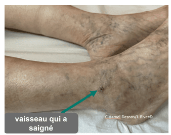 Généralités sur les varices 11 scle1