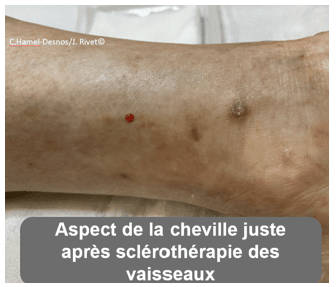 Généralités sur les varices 12 scle2