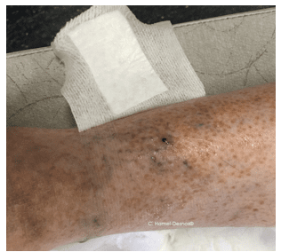 Généralités sur les varices 8
