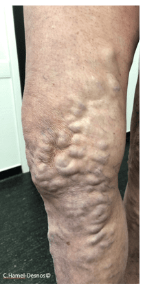 Généralités sur les varices 4 varices hommes