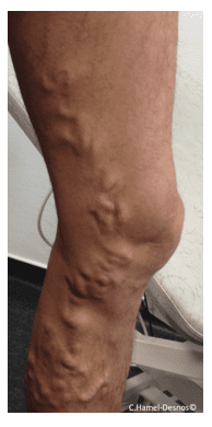 Généralités sur les varices 2 varices