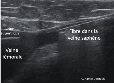 Laser endoveineux 3 echo1