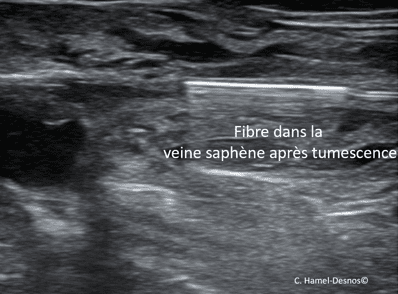 Laser endoveineux 4 echo2