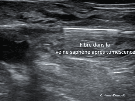 Laser endoveineux 5 echo3