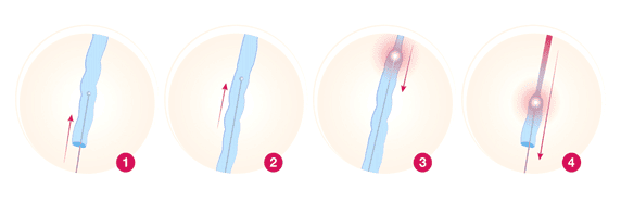 Laser endoveineux 1 laser