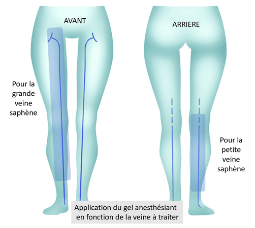 Laser endoveineux 7 preparation