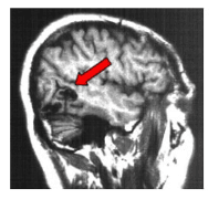 Epilepsie 2 neuro